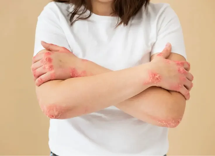 Eczema